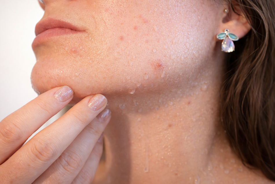 akne na bradi, policisticni jajnici